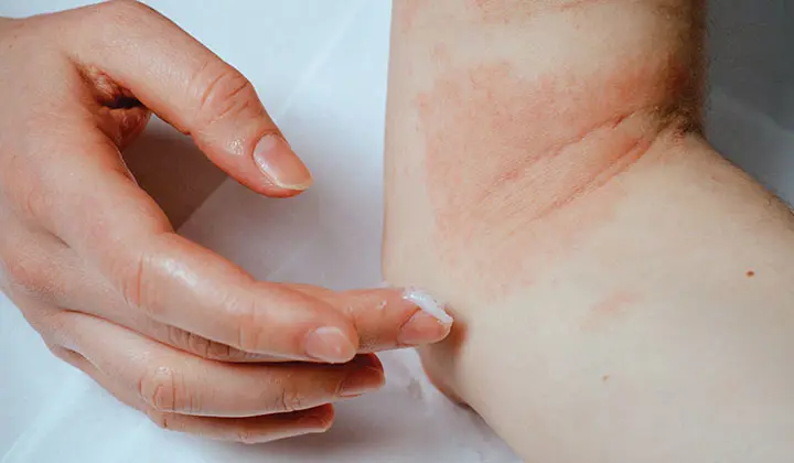 Trockene, gerötete Haut als ein Symptom der Neurodermitis