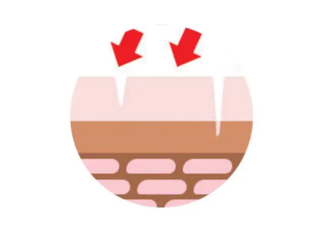 Infektionen bei Dermatitis