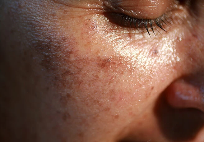 Sonnencreme & Verträglichkeit