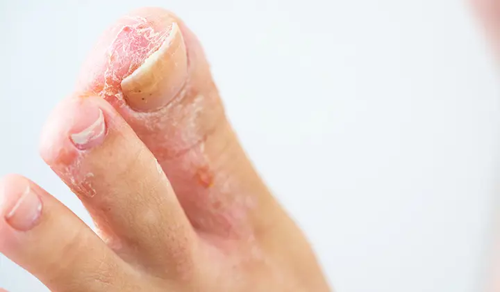 Fußpilz an den Zehen
