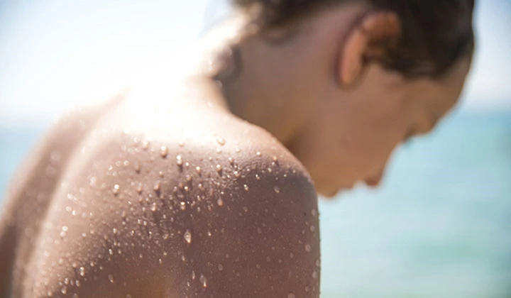 Sonnenkrankheit: Mallorca-Akne